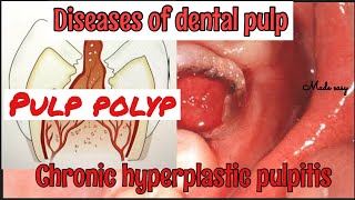 CHRONIC HYPERPLASTIC PULPITIS II PULP POLYP II DISEASES OF PULP II SERIES PART 4 II made easy [upl. by Ahsercel944]