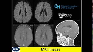 Periventricular leukomalacia in CT and MRI [upl. by Lertsek412]