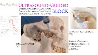 UltrasoundGuided Sphenopalatine Pterygopalatine Trigeminal Nerve Gasserian Ganglion Blocks [upl. by Alliuqaj]