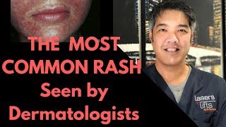 How to treat Perioral Dermatitis Dermatologist Explains [upl. by Sarajane]