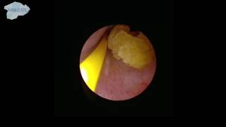 Localization of the ureter stone [upl. by Colly]