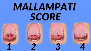 Mallampati Score Airway Assessment Technique Animation [upl. by Cioffred]