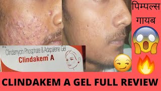 Clindakem A gel Full Review Effect abd Side Effect Best in Acne पिम्पल्स गायब होंगे इसको लो 💁💃😱💁🔥😻🔥 [upl. by Zil]