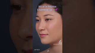 How to Get Cheek amp Jawline Contouring with Buccal Fat Removal [upl. by Edualcnaej]