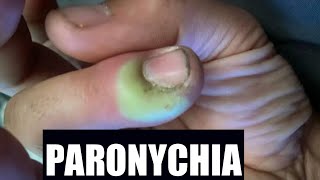 Paronychia  Katuruturu  home remedy and treatment [upl. by Aleuqahs]