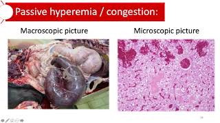 Hyperemia and congestion [upl. by Nylahs]