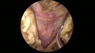 Posterior fossa transnasal exposure [upl. by Hars978]