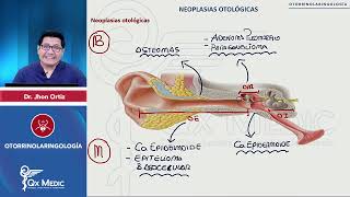 OTORRINOLARINGOLOGÍA Neoplasias otológicas Neoplasias otológicas [upl. by Elik]