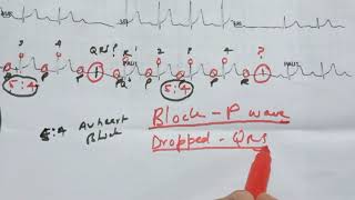 2ND DEGREE AV BLOCK TYPE 1 [upl. by Odnanref943]