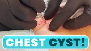 CHEST CYST [upl. by Neb]