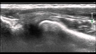 Ultrasonographic diagnosis of snapping annular ligament in the elbow [upl. by Merridie]