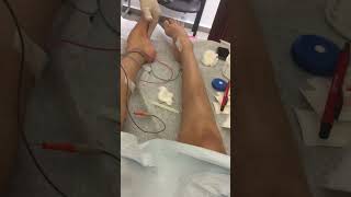 Parte de electromiografia con conducción MID [upl. by Arbmahs]