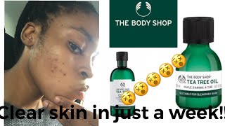 The Body shop tea tree Review Getting Rid of acne Acne Journey South African YouTuber [upl. by Netram]