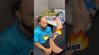 🔥3500 Grafts Hair Transplant Case with Dr Gartner  hairsurgery hairnewjersey fuehair [upl. by Waters617]