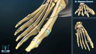 Metatarsalgia Riallineamento Metatarsale per Cedimento Arco Trasverso Anteriore [upl. by Eltotsira746]