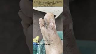 Trophic Ulcer Before After  Diabetic Foot Infection [upl. by Elleon]