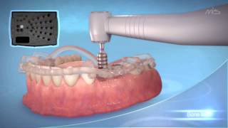 MIS Implants MGUIDE guided Implant placement procedure [upl. by Enelyad]