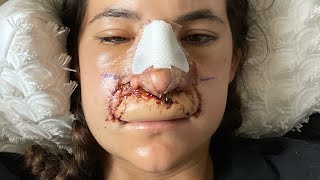 3rd SURGERY Rhinoplasty rebuild [upl. by Girand]