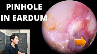 Pinhole Eardrum Perforation With White Fungal Growth In Canal [upl. by Armanda421]