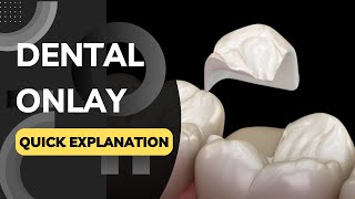 What is a Dental Onlay Quickly Explained in a Few Seconds [upl. by Eelanaj]