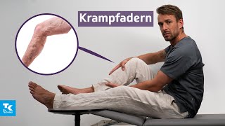 Krampfadern Varizien verstehen Ursachen Symptome Diagnose amp Therapie  DocTommy [upl. by Georglana]