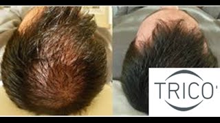 Tricopigmentazione infoltimento caduta capelli calvizie  ALOPECIA PERDITA CAPELLI [upl. by Saltsman]