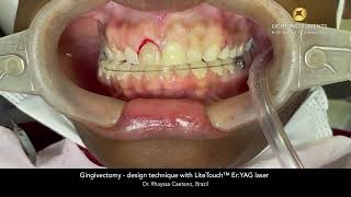 Gingivectomy  design technique with LiteTouch™ ErYAG laser [upl. by Wehrle425]