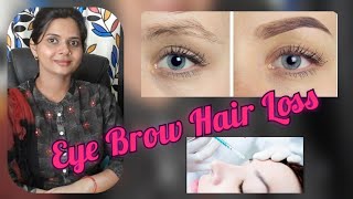 Alopecia Areata of Eyebrows Eyebrow Hair Loss Treatment of Eyebrow Hair Loss [upl. by Enahpets]