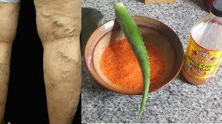 THESE 3 INGREDIENTS IS ALL YOU NEED TO GET RID OF VARICOSE VEINS NATURALLY [upl. by Castera]