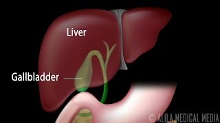 Gallstones and Surgical Removal of Gallbladder Cholecystectomy Animation [upl. by Fradin]