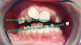 Mixed dentition stage variations congenital missing upper left lateral incisor improper alignments [upl. by Bea]