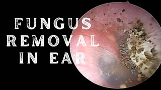 EAR AURAL TOILETING FOR OTOMYCOSIS [upl. by Eelegna690]