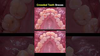 Complex braces for crowded teeth braces orthodontist dentist [upl. by Pudens]