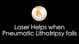 Laser Helps when Pneumatic Lithotripsy fails [upl. by Meil]