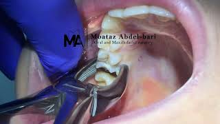 extraction of upper first molar using forceps [upl. by Hynda]