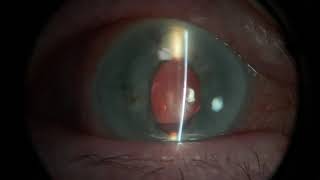 Examination of a corneal ulcer plus more [upl. by Tatianna623]