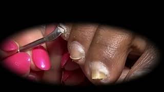 Ingrown Toenails Treatment Satisfying Pedicure Manicure 15 [upl. by Nitsugua]