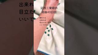 足首骨折 観察日記 術後40日目 ケロイド予防のテープは効果ありそうですshorts 骨折 足首 三果骨折 術後 傷跡 テープ fracture day40 [upl. by Inajna]