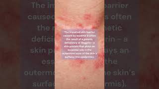 What is Eczema Atopic Dermatitis  Skin Type Solutions [upl. by Filbert]