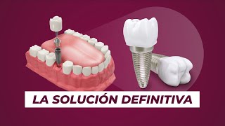 IMPLANTES DIGITALES EN ODONTOCENTER [upl. by Felicdad]