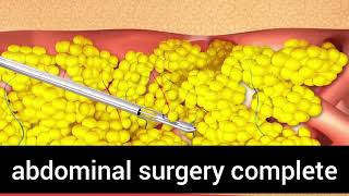 abdominal opening  anatomy viral surgeon surgeonsofsirgangaramhospital doctor surgerysimulator [upl. by Almat371]