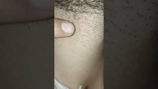 Problem after shaving beard neckline hairremovalpart5beard skincare unfrezzmyaccountviralvideo [upl. by Walliw]