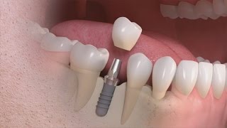 Straumann  Trattamento singolo dente su impianto [upl. by Angadreme]