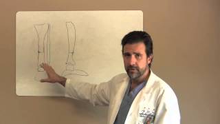 Stress Fractures amp Tibia Fractures Treatments  Sugar Land Houston TX  Dr J Michael Bennett [upl. by Nelg551]