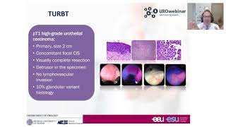 Urowebinar BCG unresponsive disease how this definition impact your treatment decision making [upl. by Drobman]