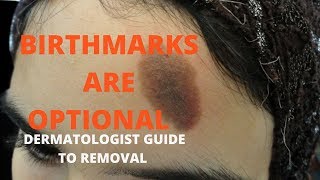 How to remove birthmarks [upl. by Demb331]