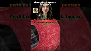 Gastric Bypass Surgery The Ultimate Guide to Stomach Shrinkage and Tips [upl. by Yddor658]