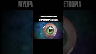 Myopia and Hypermetropia biology neet education [upl. by Odele]