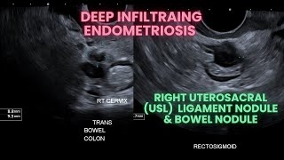 Ultrasound Deep infiltrating endometriosis Bowel nodule and uterosacral ligament nodule [upl. by Oigolue]