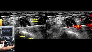 MSK US Guided Hydrodissection of Superomedial Genicular Nerve 2 [upl. by Giacinta943]